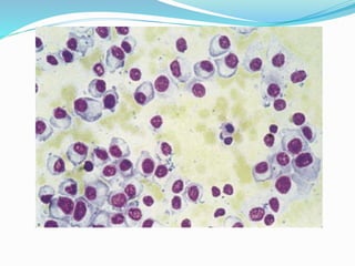 Non Hodgkin Lymphoma, cytology. | PPTX
