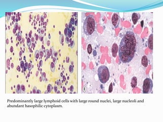 Non Hodgkin Lymphoma, cytology. | PPTX