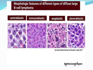 Non Hodgkin Lymphoma, cytology. | PPTX
