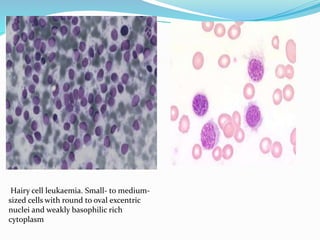 Non Hodgkin Lymphoma, cytology. | PPTX