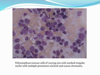 Non Hodgkin Lymphoma, cytology. | PPTX