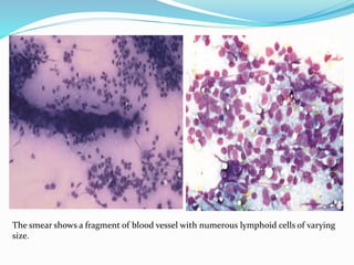 Non Hodgkin Lymphoma, cytology. | PPTX