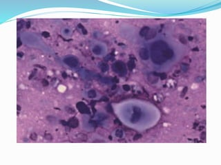 Non Hodgkin Lymphoma, cytology. | PPTX