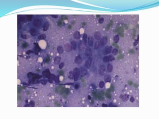 Non Hodgkin Lymphoma, cytology. | PPTX