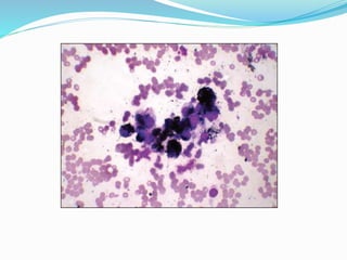 Non Hodgkin Lymphoma, cytology. | PPTX