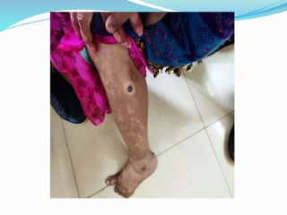 Non Hodgkin Lymphoma, cytology. | PPTX