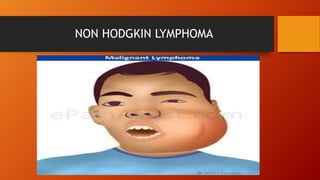 NON HODGKIN LYMPHOMA
 