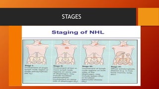 STAGES
 