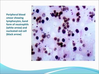 Peripheral blood
smear showing
lymphocytes, band
form of neutrophils
(white arrow) and
nucleated red cell
(black arrow)
 