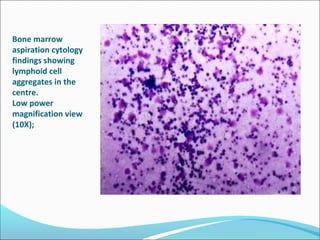 Bone marrow
aspiration cytology
findings showing
lymphoid cell
aggregates in the
centre.
Low power
magnification view
(10X);
 