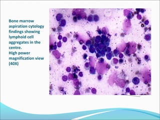 Bone marrow
aspiration cytology
findings showing
lymphoid cell
aggregates in the
centre.
High power
magnification view
(40X)
 