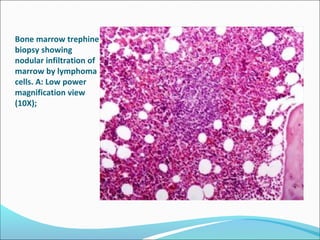 Bone marrow trephine
biopsy showing
nodular infiltration of
marrow by lymphoma
cells. A: Low power
magnification view
(10X);
 