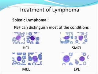 Treatment of Lymphoma
Splenic Lymphoma :
PBF can distinguish most of the conditions
HCL SMZL
MCL LPL
 