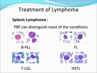 Treatment of Lymphoma
Splenic Lymphoma :
PBF can distinguish most of the conditions
B-PLL FL
T-LGL HSTL
 