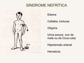 SÍNDROME NEFRÍTICA
Edema
Cefaléia, tonturas
Olígúria
Urina escura (cor de
mate ou de Coca-cola)
Hipertensão arterial
Hematúria
 