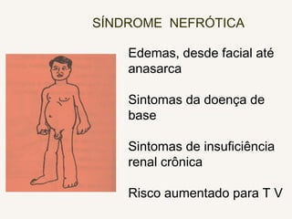 SÍNDROME NEFRÓTICA
Edemas, desde facial até
anasarca
Sintomas da doença de
base
Sintomas de insuficiência
renal crônica
Risco aumentado para T V
 