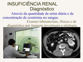 INSUFICIÊNCIA RENAL
Diagnóstico
Através da quantidade de urina diária e da
concentração de creatinina no sangue.
Exames laboratoriais, físicos e de
diagnóstico por imagem investigam a etiologia.
 