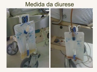 Medida da diurese
 