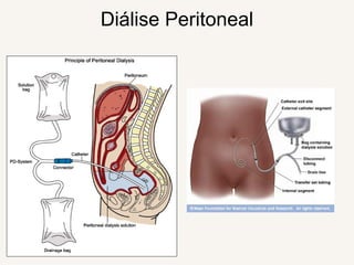 Diálise Peritoneal
 
