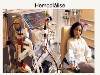 Hemodiálise
 