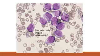 Auer rods, oddly
shaped,
increased N:C
 