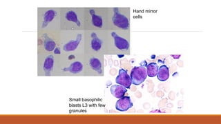 Small basophilic
blasts L3 with few
granules
Hand mirror
cells
 