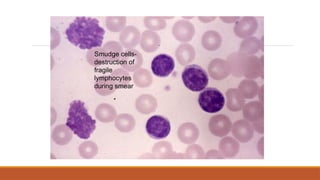 Smudge cells-
destruction of
fragile
lymphocytes
during smear
 