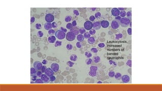 Leukocytosis,
increased
numbers of
banded
neutrophils
 