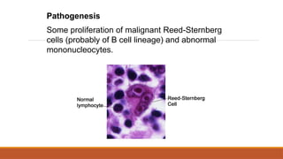 Pathogenesis
Some proliferation of malignant Reed-Sternberg
cells (probably of B cell lineage) and abnormal
mononucleocytes.
 