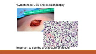 •Lymph node USS and excision biopsy
Important to see the architecture of the LN!
 