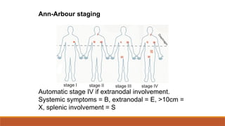 Ann-Arbour staging
Automatic stage IV if extranodal involvement.
Systemic symptoms = B, extranodal = E, >10cm =
X, splenic involvement = S
 