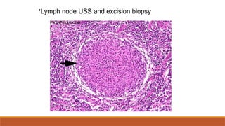 •Lymph node USS and excision biopsy
 