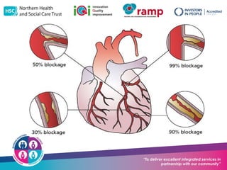 Nhsct NHSCT-Angina-Powerpoint (2).potx CARDIAC SURGERY | POTX