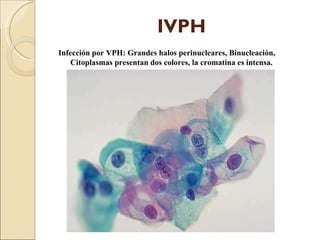 IVPH Infección por VPH: Grandes halos perinucleares, Binucleación, Citoplasmas presentan dos colores, la cromatina es intensa. 