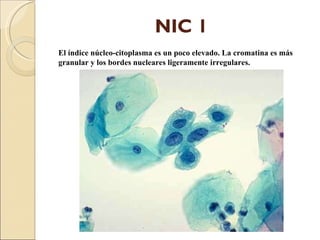 NIC 1 El índice núcleo-citoplasma es un poco elevado. La cromatina es más granular y los bordes nucleares ligeramente irregulares. 