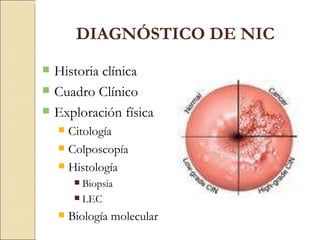 DIAGNÓSTICO DE NIC Historia clínica Cuadro Clínico Exploración física Citología Colposcopía Histología Biopsia LEC Biología molecular 