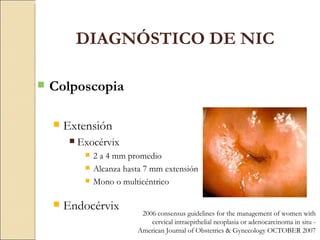 Colposcopia Extensión Exocérvix 2 a 4 mm promedio Alcanza hasta 7 mm extensión Mono o multicéntrico  Endocérvix DIAGNÓSTICO DE NIC 2006 consensus guidelines for the management of women with cervical intraepithelial neoplasia or adenocarcinoma in situ -  American Journal of Obstetrics & Gynecology OCTOBER 2007 