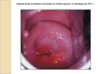  Delgada lesión acetoblanca con bordes en el labio superior. La histología fue NIC 1.   