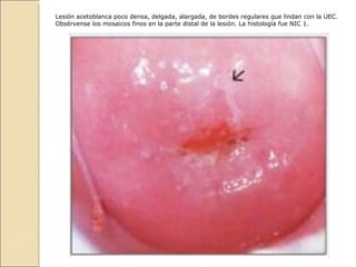 Lesión acetoblanca poco densa, delgada, alargada, de bordes regulares que lindan con la UEC. Obsérvense los mosaicos finos en la parte distal de la lesión. La histología fue NIC 1.   