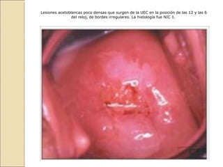 Lesiones acetoblancas poco densas que surgen de la UEC en la posición de las 12 y las 6 del reloj, de bordes irregulares. La histología fue NIC 1.   