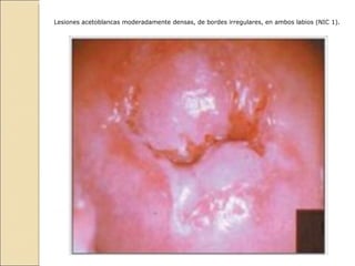 Lesiones acetoblancas moderadamente densas, de bordes irregulares, en ambos labios (NIC 1).   