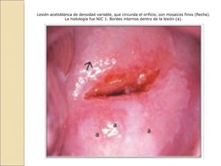 Lesión acetoblanca de densidad variable, que circunda el orificio, con mosaicos finos (flecha). La histología fue NIC 1. Bordes internos dentro de la lesión (a). 