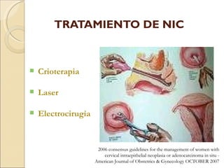 TRATAMIENTO DE NIC Crioterapia Laser Electrocirugía 2006 consensus guidelines for the management of women with cervical intraepithelial neoplasia or adenocarcinoma in situ -  American Journal of Obstetrics & Gynecology OCTOBER 2007 