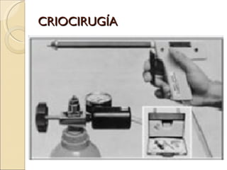CRIOCIRUGÍA 