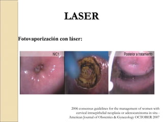 LASER 2006 consensus guidelines for the management of women with cervical intraepithelial neoplasia or adenocarcinoma in situ -  American Journal of Obstetrics & Gynecology OCTOBER 2007 Fotovaporización con láser: 