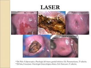 LASER De Palo. Colposcopia y Patología del tracto genital inferior. Ed. Panamericana. 2ª edición. Di Saia, Creasman. Oncología Ginecológica clínica. Ed. Harcourt. 6ª edición. 