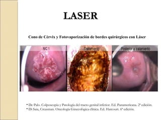 LASER De Palo. Colposcopia y Patología del tracto genital inferior. Ed. Panamericana. 2ª edición. Di Saia, Creasman. Oncología Ginecológica clínica. Ed. Harcourt. 6ª edición. Cono de Cérvix y Fotovaporización de bordes quirúrgicos con Láser   