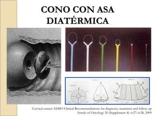 CONO CON ASA DIATÉRMICA Cervical cancer: ESMO Clinical Recommendations for diagnosis, treatment and follow-up Annals of Oncology 20 (Supplement 4): iv27–iv28, 2009 