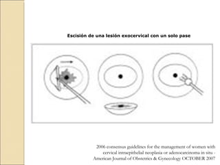 Escisión de una lesión exocervical con un solo pase 2006 consensus guidelines for the management of women with cervical intraepithelial neoplasia or adenocarcinoma in situ -  American Journal of Obstetrics & Gynecology OCTOBER 2007 
