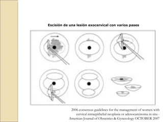 Escisión de una lesión exocervical con varios pases   2006 consensus guidelines for the management of women with cervical intraepithelial neoplasia or adenocarcinoma in situ -  American Journal of Obstetrics & Gynecology OCTOBER 2007 